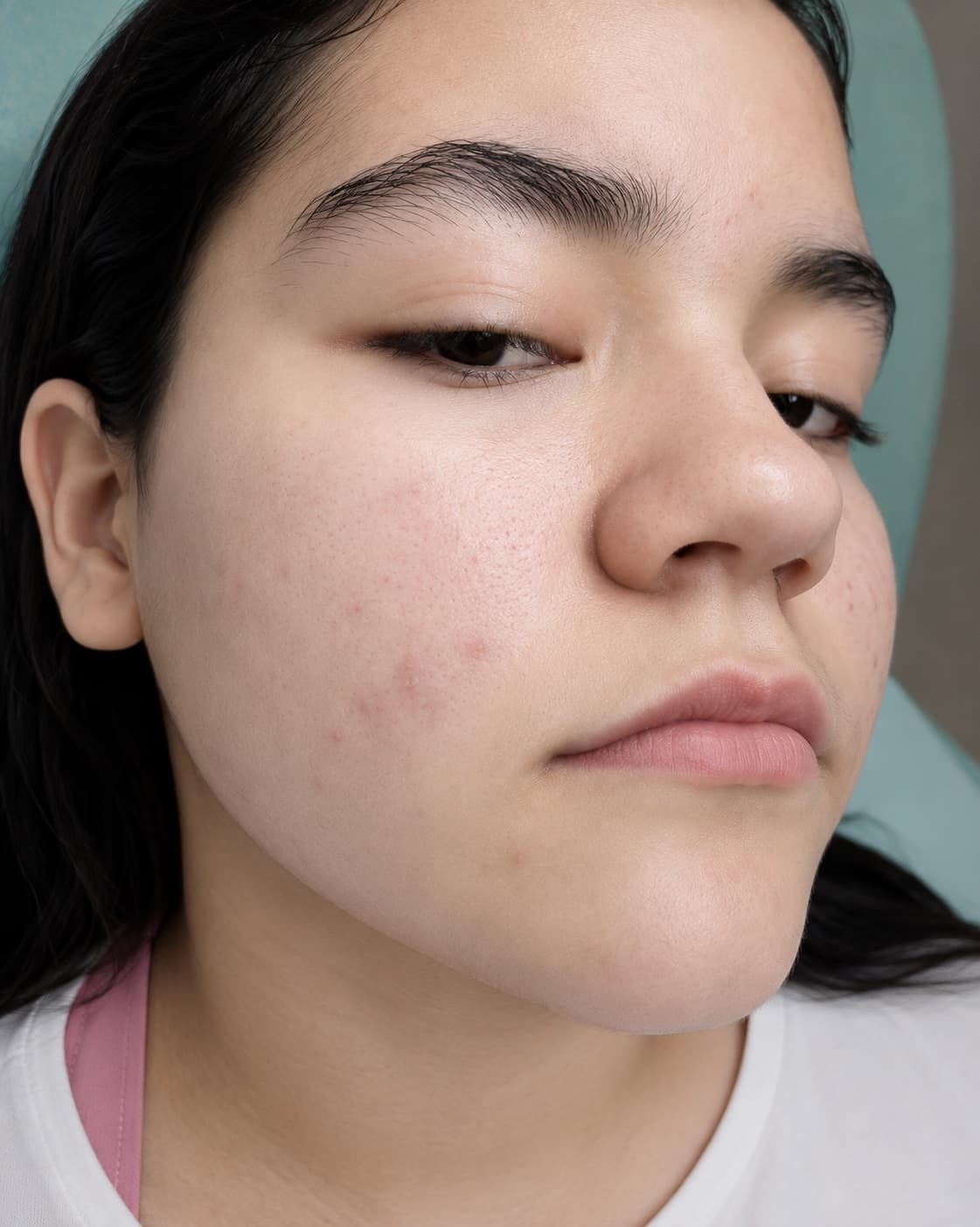 Limpieza Facial Adolescente