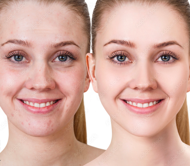 tratamiento de limpieza facial para adolescentes berkespa